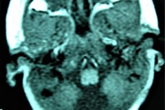 mastoiditis-der-tac-rnm-1m-2005-015