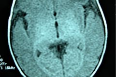 mastoiditis-der-tac-rnm-1m-2005-016