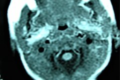 mastoiditis-der-tac-rnm-1m-2005-017