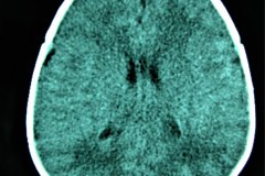 mastoiditis-der-tac-rnm-1m-2005-018