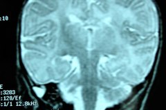 mastoiditis-der-tac-rnm-1m-2005-019