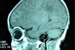 mastoiditis-der-tac-rnm-1m-2005-020