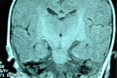 mastoiditis-der-tac-rnm-1m-2005-021