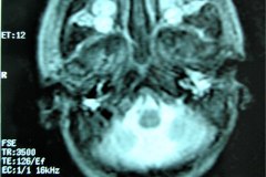 mastoiditis-der-tac-rnm-1m-2005-022