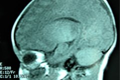 mastoiditis-der-tac-rnm-1m-2005-023