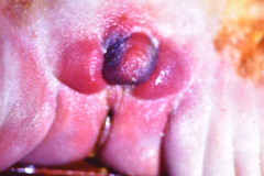 mayer-rokitansky-kuster-hauser-o-murcs-aplasia-del-conducto-mulleriano-displasia-renal-anomalias-de-los-somitas-cervicales-1986-003