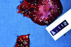 mayer-rokitansky-kuster-hauser-o-murcs-aplasia-del-conducto-mulleriano-displasia-renal-anomalias-de-los-somitas-cervicales-1986-004