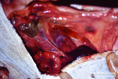 mayer-rokitansky-kuster-hauser-o-murcs-aplasia-del-conducto-mulleriano-displasia-renal-anomalias-de-los-somitas-cervicales-1986-006
