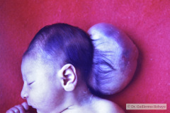 meckel-gruber-encefalocele-occipital-derivacion-ventriculo-peritoneal-004