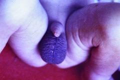 meckel-gruber-encefalocele-occipital-derivacion-ventriculo-peritoneal-006