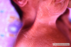 meckel-gruber-encefalocele-occipital-labio-paladar-izq-hendidos-pterigium-colli-mano-trisomica-sindactilia-pie-der-talo-valgo-der-equino-varo-izq-queratoris-pilar-1994-004