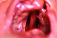 meckel-gruber-encefalocele-occipital-labio-paladar-izq-hendidos-pterigium-colli-mano-trisomica-sindactilia-pie-der-talo-valgo-der-equino-varo-izq-queratoris-pilar-1994-005