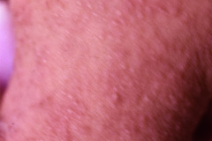 meckel-gruber-encefalocele-occipital-labio-paladar-izq-hendidos-pterigium-colli-mano-trisomica-sindactilia-pie-der-talo-valgo-der-equino-varo-izq-queratoris-pilar-1994-011