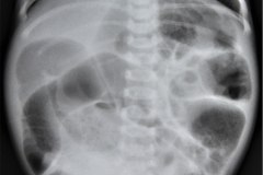 megacolon-1985-000