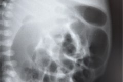 megacolon-con-enterocolitis-1987-000