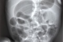megacolon-con-enterocolitis-1987-001