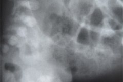 megacolon-con-enterocolitis-1987-002