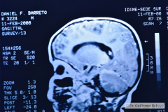 melanosis-neuro-cutanea-007