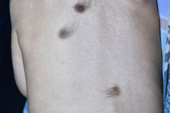 melanosis-neuro-cutanea-009