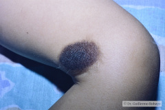 melanosis-neuro-cutanea-010