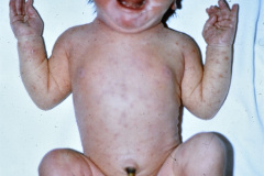 melanosis-pustulosa-neonatal-transitoria-2001-001