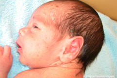 melanosis-pustulosa-neonatal-transitoria-2010-002