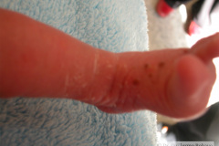 melanosis-pustulosa-neonatal-transitoria-2010-011