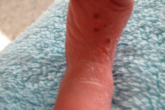 melanosis-pustulosa-neonatal-transitoria-2010-014