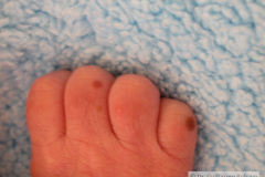 melanosis-pustulosa-neonatal-transitoria-2010-016