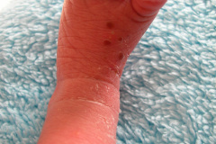 melanosis-pustulosa-neonatal-transitoria-2010-017