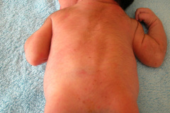 melanosis-pustulosa-neonatal-transitoria-2010-022