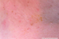 melanosis-pustulosa-neonatal-transitoria-2010-023