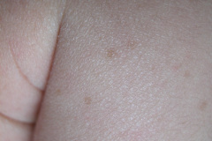 melanosis-pustulosa-neonatal-transitoria-5d-2005-001