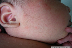 melanosis-pustulosa-neonatal-transitoria-5d-2005-002