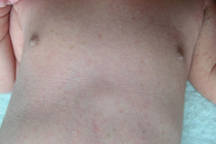 melanosis-pustulosa-neonatal-transitoria-5d-2005-003