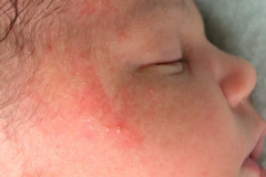 melanosis-pustulosa-neonatal-transitoria-5d-2005-005