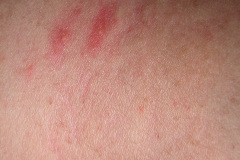 melanosis-pustulosa-neonatal-transitoria-5d-2005-007
