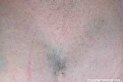 melanosis-pustulosa-neonatal-transitoria-5d-2005-008