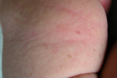 melanosis-pustulosa-neonatal-transitoria-5d-2005-009