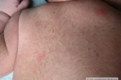 melanosis-pustulosa-neonatal-transitoria-5d-2005-014