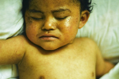 melanosis-pustulosa-neonatal-transitoria-000