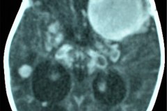 meningioma-cerebral-frontoparietal-izq-2003-003