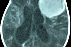 meningioma-cerebral-frontoparietal-izq-2003-004