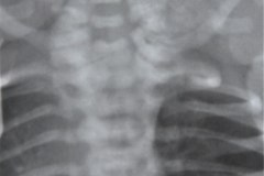 meningocele-cervical-1988-000