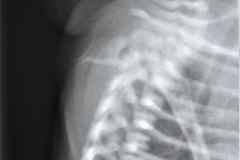 meningocele-cervical-1988-003