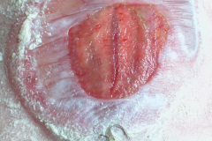 meningocele-lumbar-esfinter-anal-tonico-2004-001