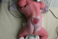 meningocele-lumbar-esfinter-anal-tonico-2004-004