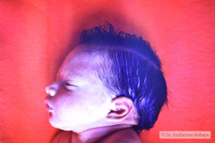 meningocele-lumbar-raquisquisis-000