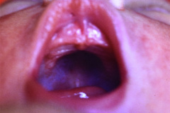 meningocele-lumbar-raquisquisis-003