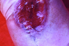 meningocele-lumbar-raquisquisis-005